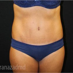 Tummy Tuck Before & After Patient #2843