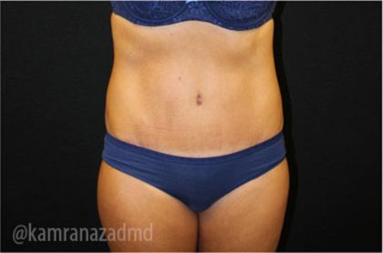 Tummy Tuck Before & After Patient #2843