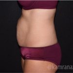 Tummy Tuck Before & After Patient #2843