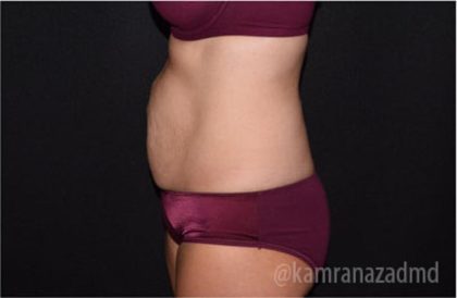Tummy Tuck Before & After Patient #2843