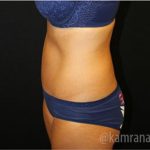Tummy Tuck Before & After Patient #2843