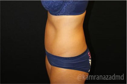Tummy Tuck Before & After Patient #2843