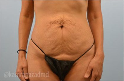 Tummy Tuck Before & After Patient #2844