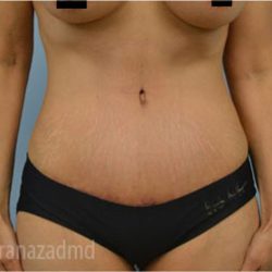Tummy Tuck Before & After Patient #2844