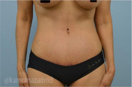 Tummy Tuck Before & After Patient #2844