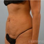 Tummy Tuck Before & After Patient #2844