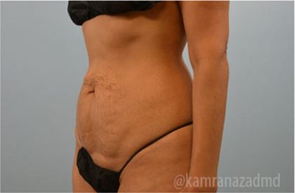 Tummy Tuck Before & After Patient #2844