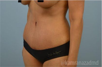 Tummy Tuck Before & After Patient #2844