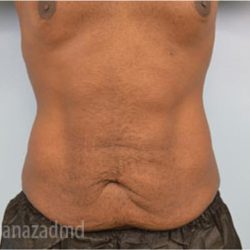 Tummy Tuck Before & After Patient #2845