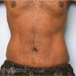 Tummy Tuck Before & After Patient #2845