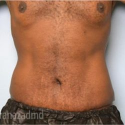 Tummy Tuck Before & After Patient #2845
