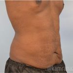 Tummy Tuck Before & After Patient #2845