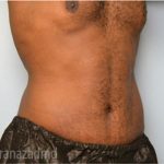 Tummy Tuck Before & After Patient #2845