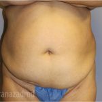 Tummy Tuck Before & After Patient #2846