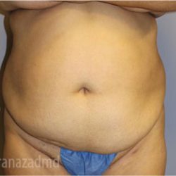 Tummy Tuck Before & After Patient #2846