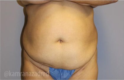 Tummy Tuck Before & After Patient #2846