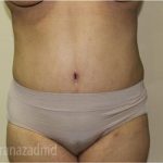 Tummy Tuck Before & After Patient #2846
