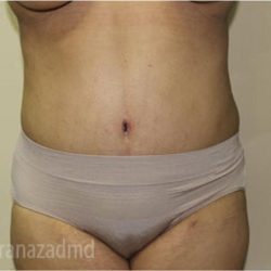 Tummy Tuck Before & After Patient #2846