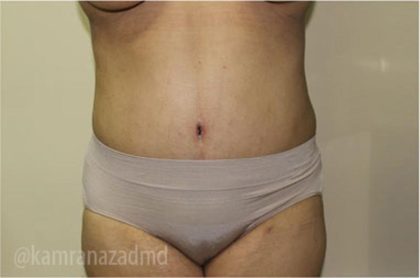 Tummy Tuck Before & After Patient #2846