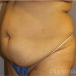 Tummy Tuck Before & After Patient #2846