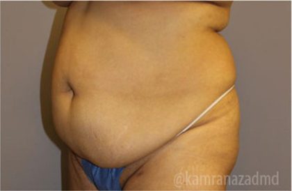 Tummy Tuck Before & After Patient #2846
