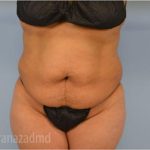 Tummy Tuck Before & After Patient #2847