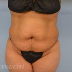 Tummy Tuck Before & After Patient #2847