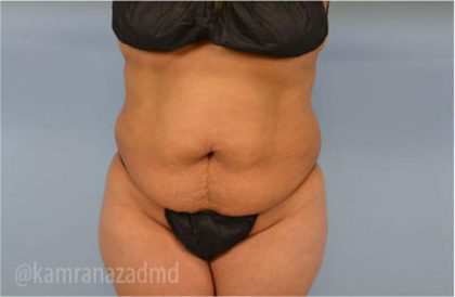 Tummy Tuck Before & After Patient #2847