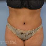 Tummy Tuck Before & After Patient #2847