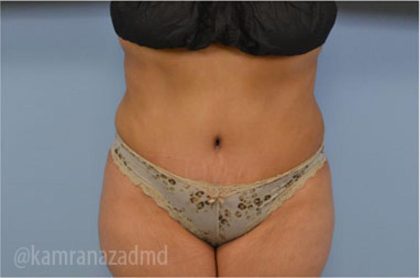 Tummy Tuck Before & After Patient #2847