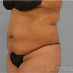 Tummy Tuck Before & After Patient #2847