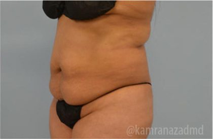 Tummy Tuck Before & After Patient #2847