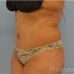 Tummy Tuck Before & After Patient #2847