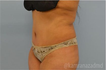 Tummy Tuck Before & After Patient #2847