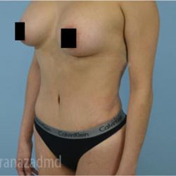 Tummy Tuck Before & After Patient #2848
