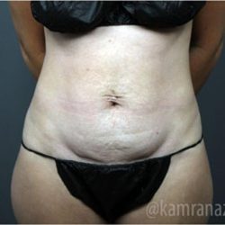 Tummy Tuck Before & After Patient #2849