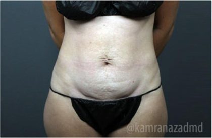 Tummy Tuck Before & After Patient #2849