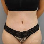 Tummy Tuck Before & After Patient #2849