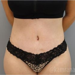 Tummy Tuck Before & After Patient #2849