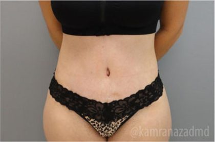 Tummy Tuck Before & After Patient #2849