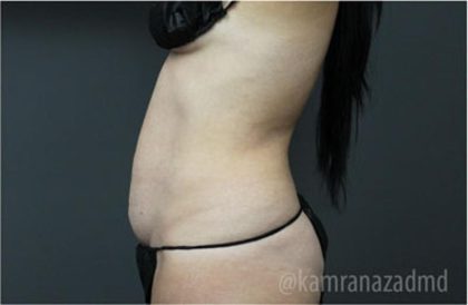 Tummy Tuck Before & After Patient #2849