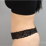 Tummy Tuck Before & After Patient #2849