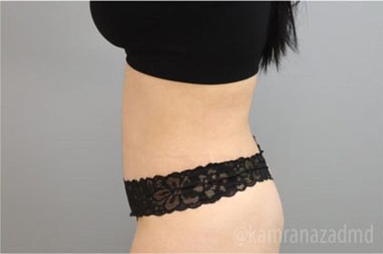 Tummy Tuck Before & After Patient #2849
