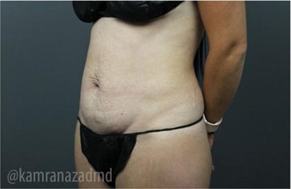 Tummy Tuck Before & After Patient #2849