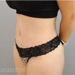 Tummy Tuck Before & After Patient #2849