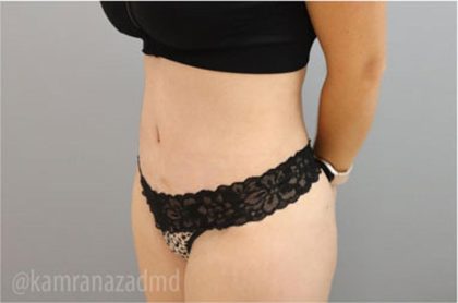 Tummy Tuck Before & After Patient #2849
