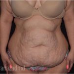 Tummy Tuck Before & After Patient #2850