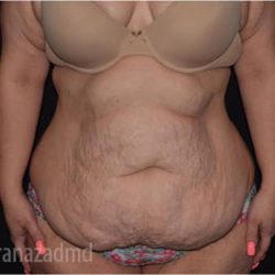 Tummy Tuck Before & After Patient #2850