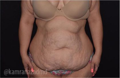 Tummy Tuck Before & After Patient #2850