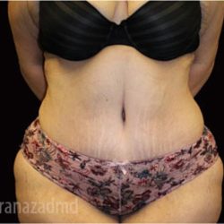 Tummy Tuck Before & After Patient #2850